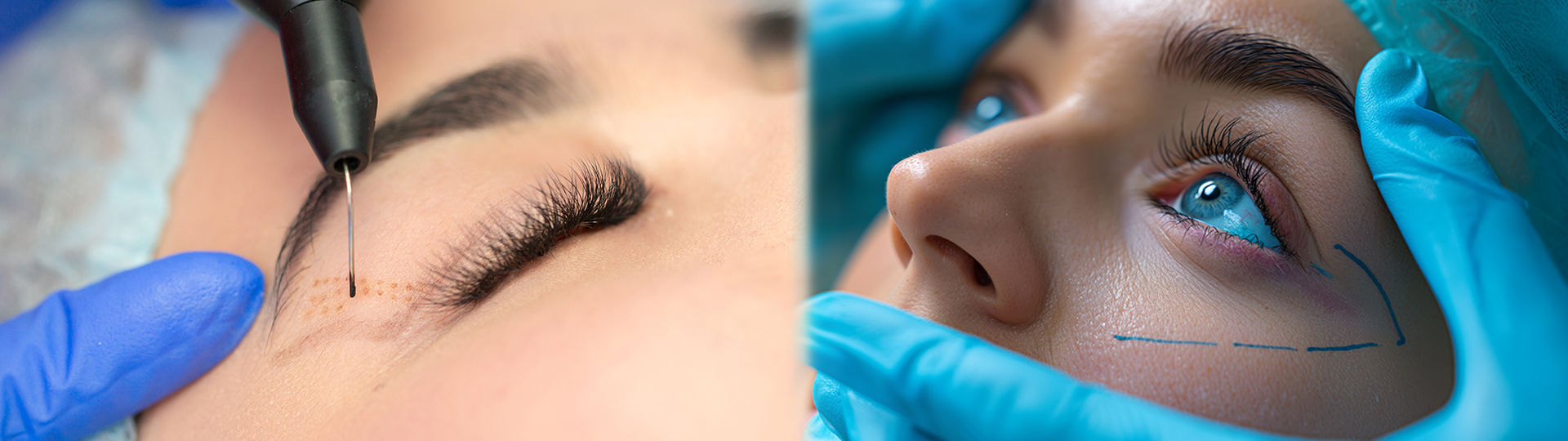 Chirurgie esthétique des paupières à la Clinique du Ter